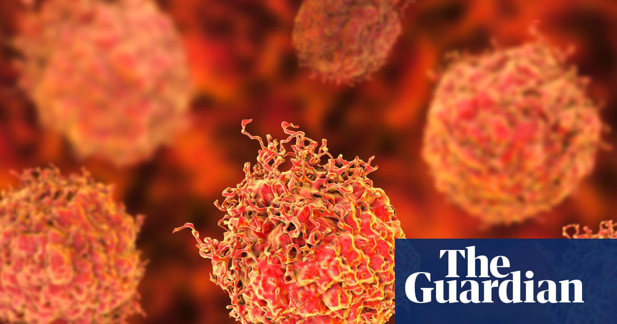 Des chercheurs saluent des résultats « époustouflants » d'un nouveau traitement contre le cancer de la prostate !